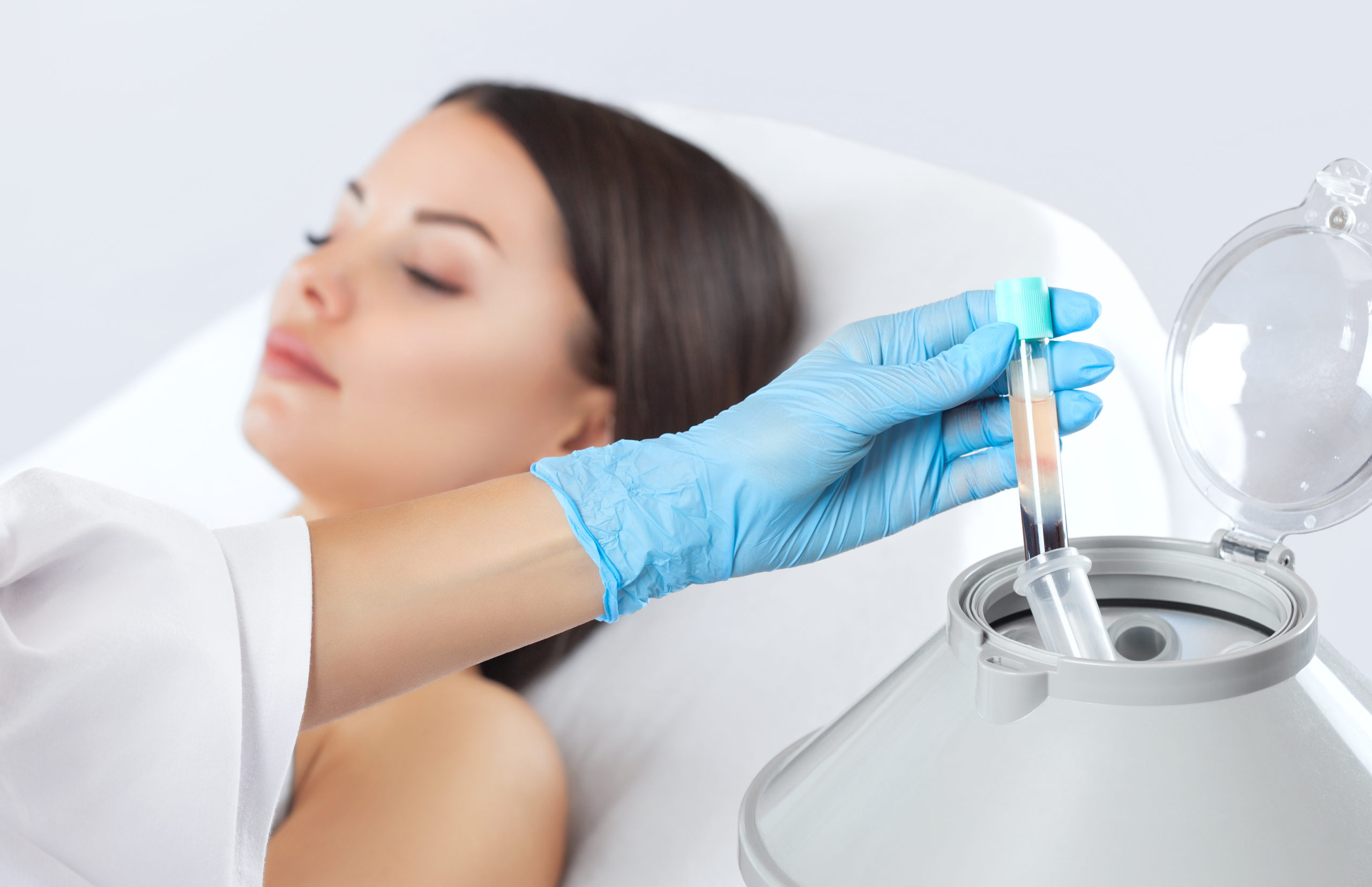 The blood tube is removed from the medical centrifuge for plasma lifting. Prp procedure.